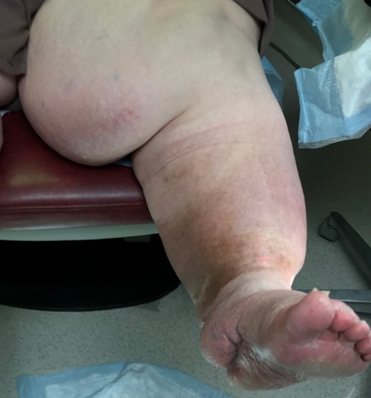 Lymphedema - non-pitting edema. By Scott Robinson, MD