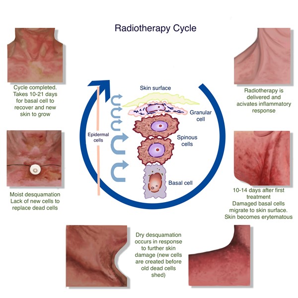 Skin changes during the radiotherapy cycle