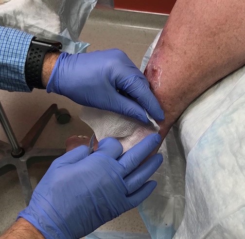 Hold the gauze with the CTP and apply the CTP on the wound