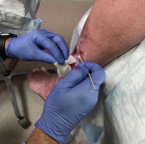 Peel away gauze while holding CTP in place