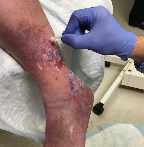 Apply wound glue in the periwound to secure silicone contact layer