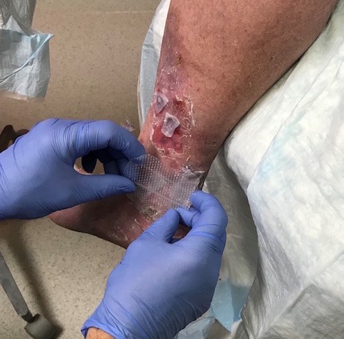  Apply silicone contact layer on top of the CTP, covering periwound as well