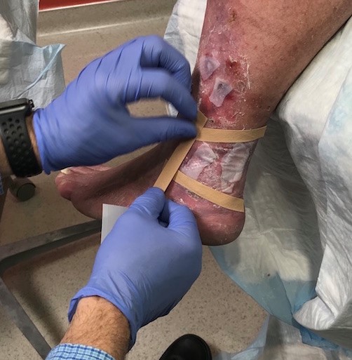 Secure contact layer with skin closure strips