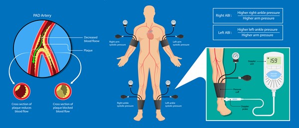 Calculating the ankle-brachial index for each side  