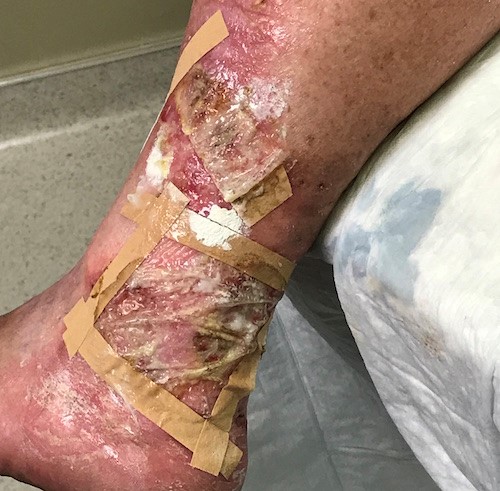 Follow-up 1 week post CTP application. Secondary absorptive dressing removed