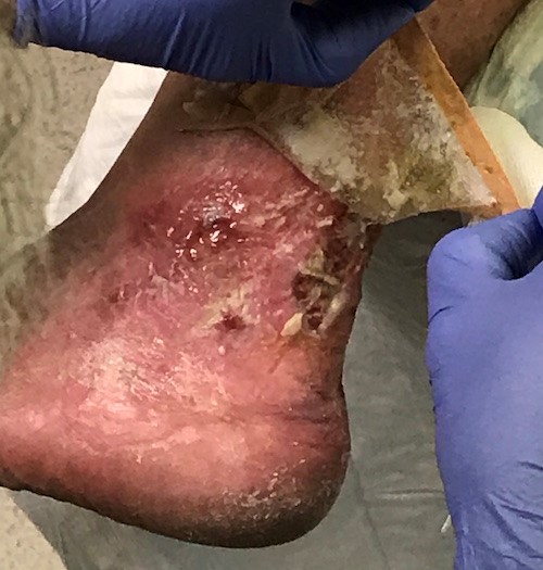 Silicone contact layer removed