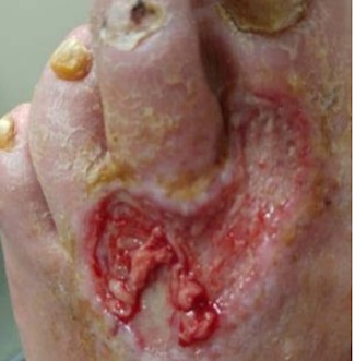 Debridement of wound bed with curette, removal of fibrin