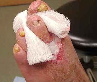  Application of silicone contact layer on CTP.