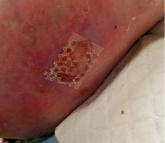 Meshed configuration of the CTP is applied on the ulcer so as to overlap wound edges by 1-2mm 