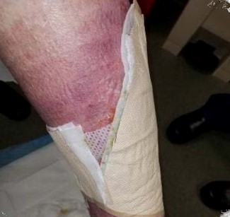 Cross-sectional cut illustrating dressing layers.