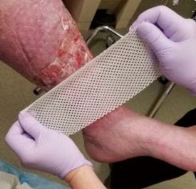 CTP is covered and secured with non-adherent silicone contact layer  