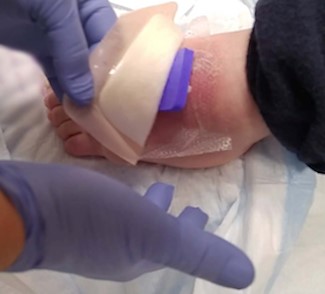  External foam dressing cover applied over antimicrobial dressing to provide extra padding 