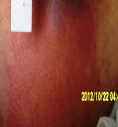 Stage 1 Pressure Injury. Babagolzadeh, from Wikimedia Commons