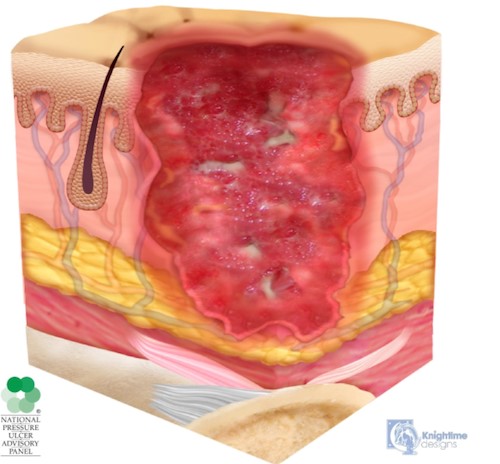 Stage 3 Pressure Ulcer/Injury