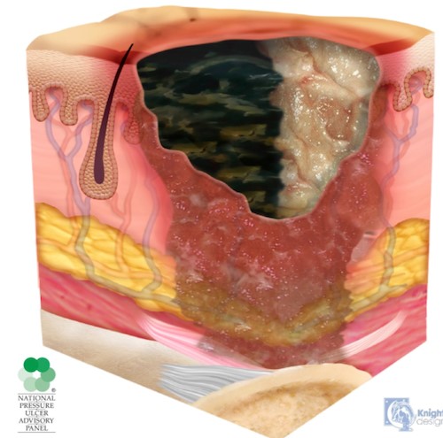 Unstageable pressure ulcer/injury