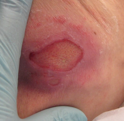 Stage 2 Pressure ulcer in the coccyx. Lebendiskaya N, RN, BSN, CWOCN