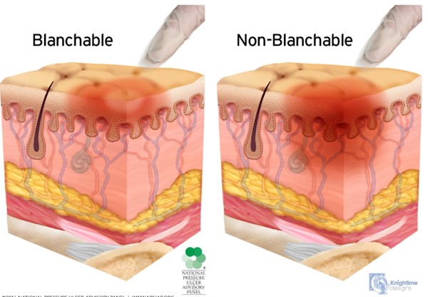 Blanchable and non-blanchable erythema