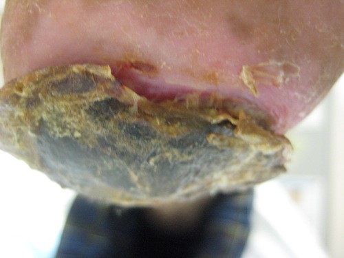 Unstageable pressure ulcer/injury in the heel. Lebendiskaya N, RN, BSN, CWOCN