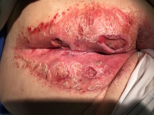 Incontinence associated dermatitis and stage 2 pressure ulcer/injury. Robinson S, MD