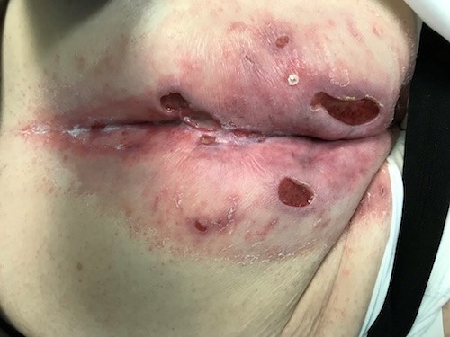 Incontinence associated dermatitis treated with barrier film and stage 2 PU/PI. Robinson S, MD