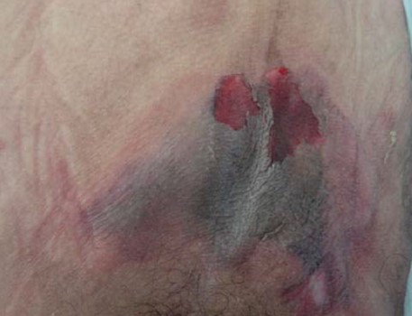 Kennedy Terminal Ulcer - horseshoe shaped