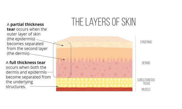 Severity of skin tears can vary by depth