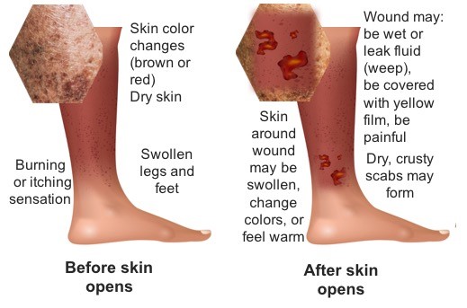 1. Leg appearance before and after skin opens