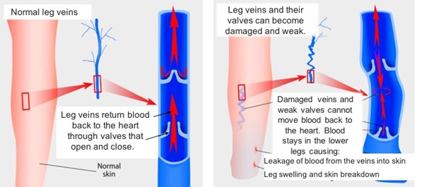2. Normal and damaged veins