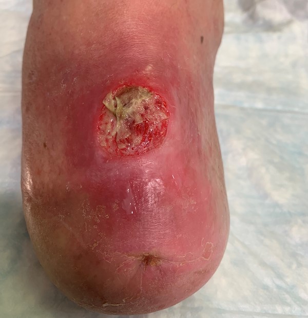 Ulcer on an amputated limb pre debridement