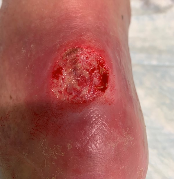 Ulcer on an amputated limb after debridement