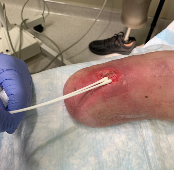 Wound swab collection