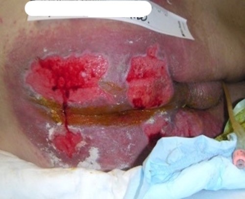 2. Incontinence associated dermatitis