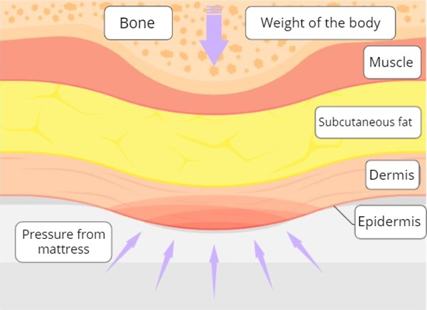 How pressure ulcers/injuries develop