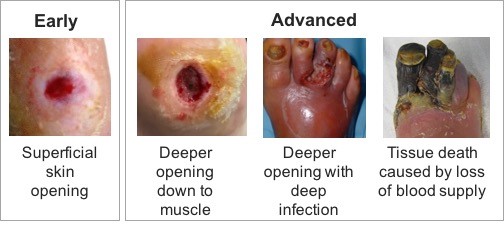 1. Early and advanced stages of diabetic foot ulcers