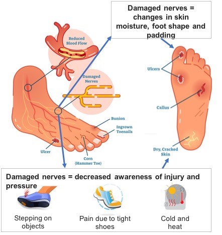 2. Causes of a diabetic foot ulcer