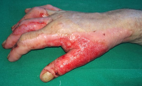 Acute burn on hand - Deep partial thickness (deep second degree). By Oliveira AF, MD, PhD