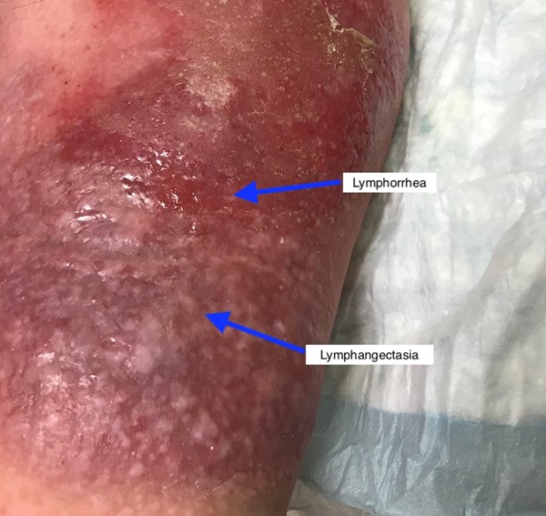 Lymphangectasia and lymphorrhea