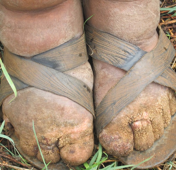  Elephantiasis nostras verrucosa. Fasil Ayele , NIH [Public domain]