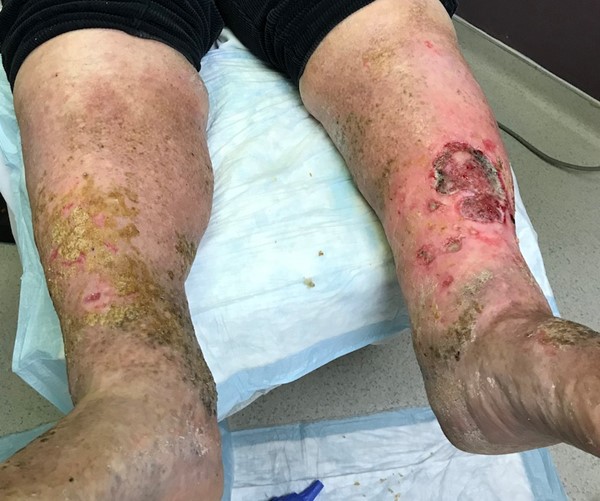 Phlebolymphedema and ulcer