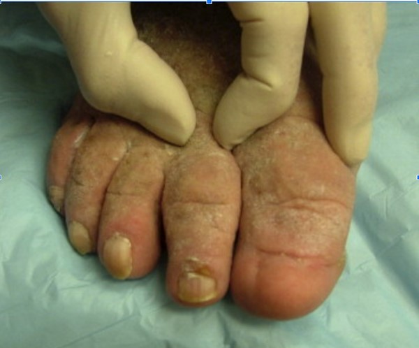 Inability to raise skinfolds between fingers