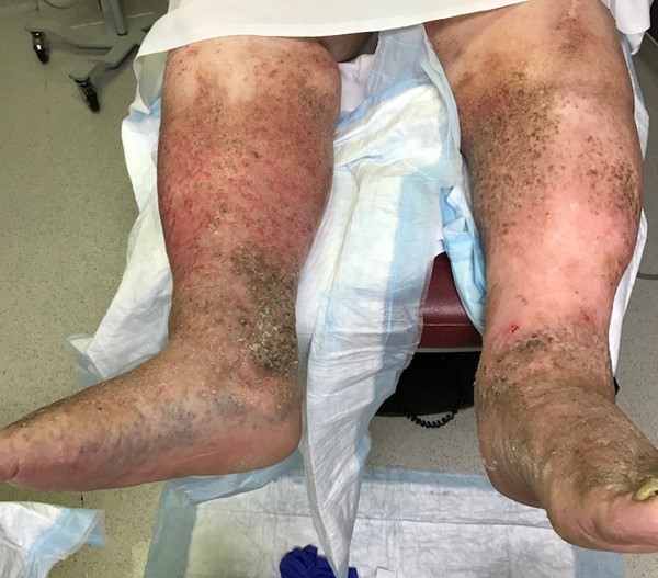 Phlebolymphedema