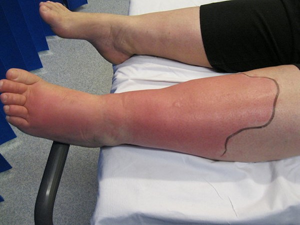Cellulitis