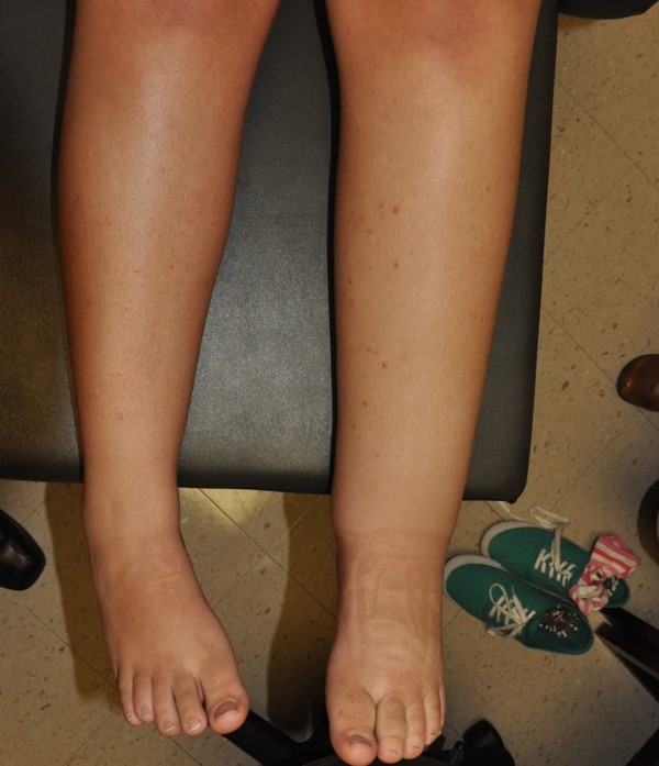 Primary lymphedema, left lower extremity
