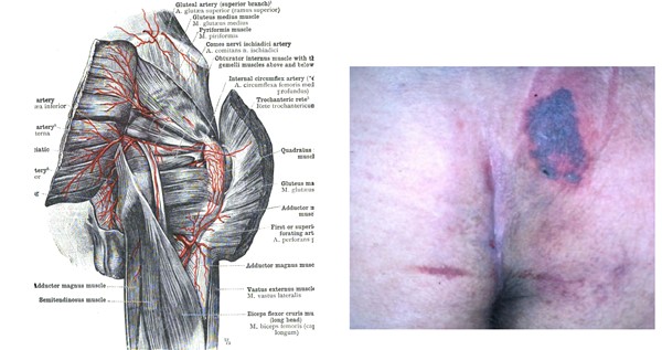 3:30 syndrome, a type of Kennedy Terminal Ulcer