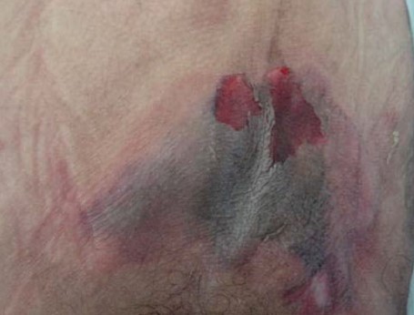 Kennedy terminal ulcer