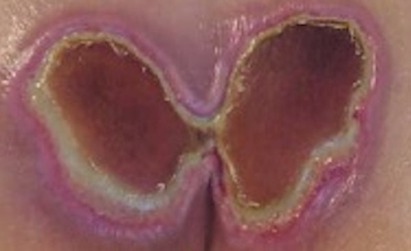 Butterly-shaped Kennedy Terminal Ulcer. By Catherine Milne APRN, MSN, CWOCN-AP