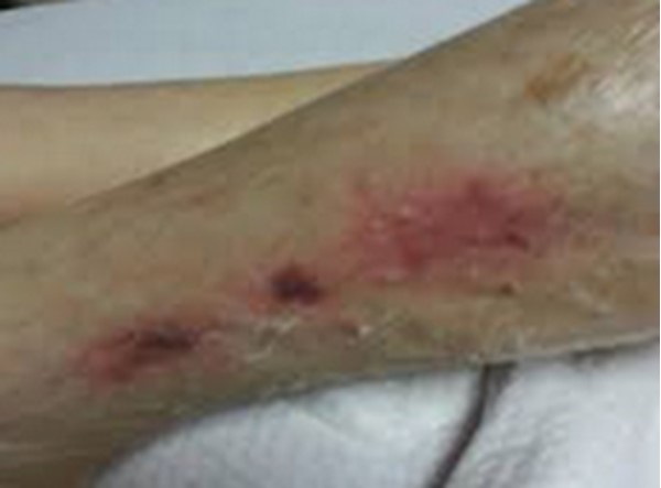 Trombley-Brennan terminal tissue injuries. By Catherine Milne, APRN, MSN, CWOCN-AP