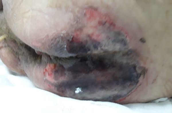 Skin failure. By Idevania Costa, Ph.D., NSWOC, RN