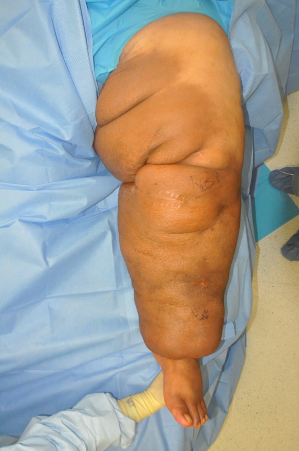 Charles procedure. Pre-operative frontal view