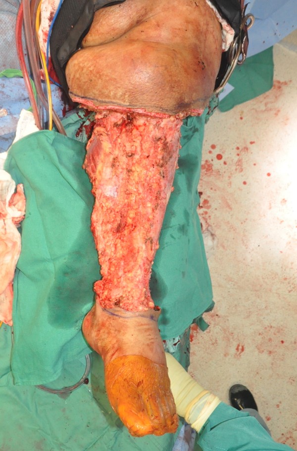 Charles procedure. Intra-operative frontal view